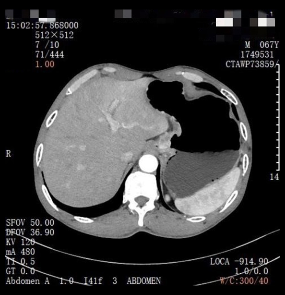 Case 1: Computed tomography for the diagnosis of esophageal and gastric junction carcinoma.