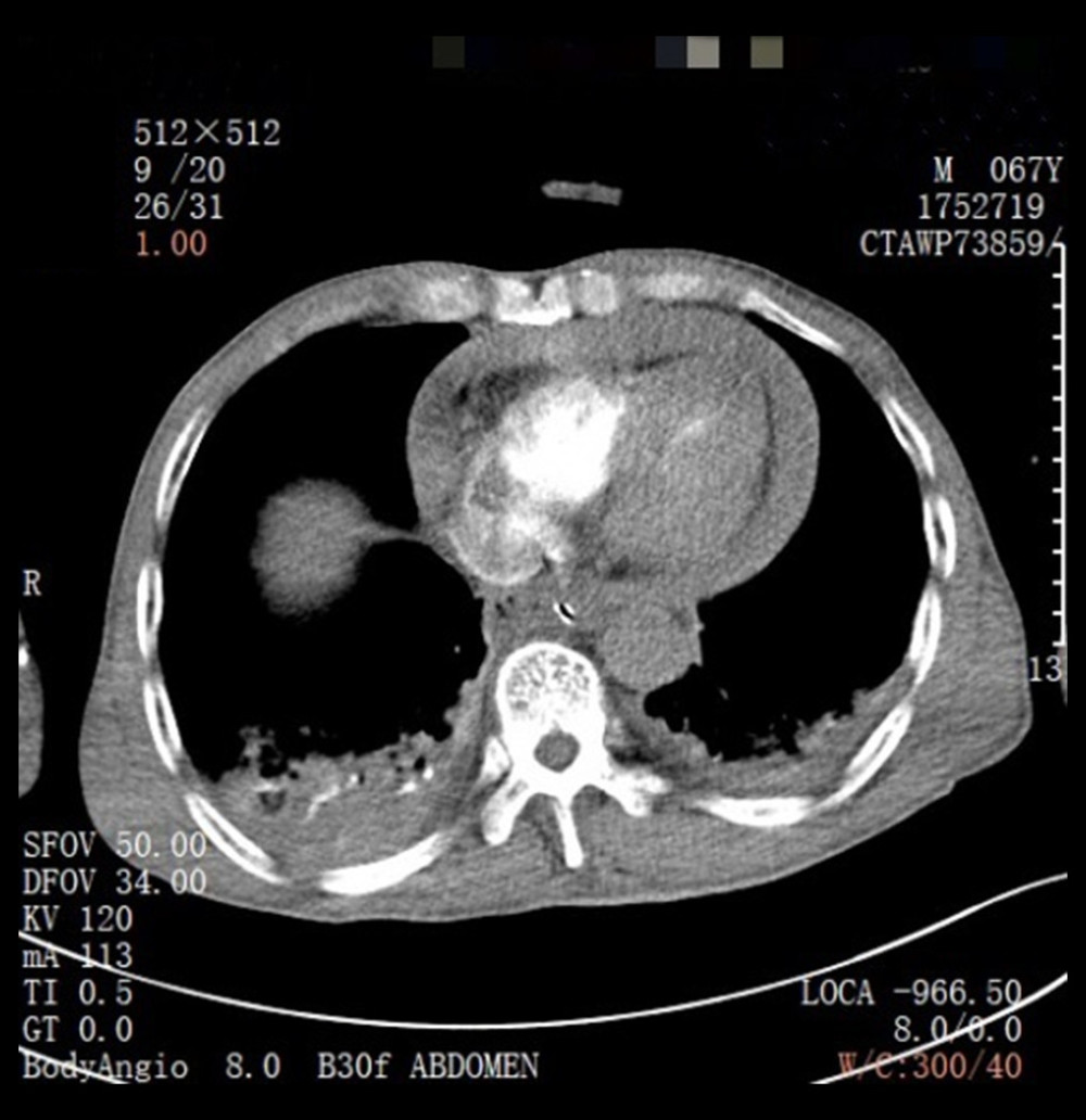 Case 1: Computed tomography indicates pericardial effusion.