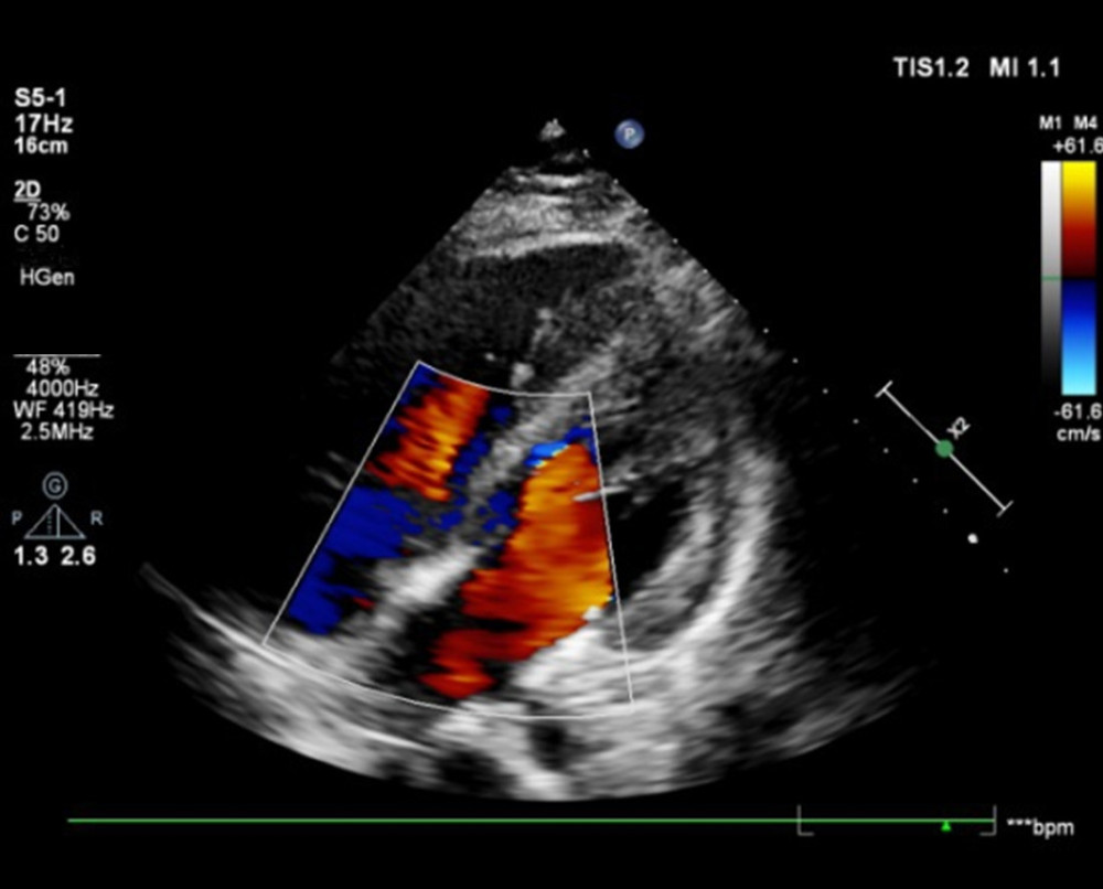 Case 1: Pericardial color ultrasound indicates pericardial effusion.