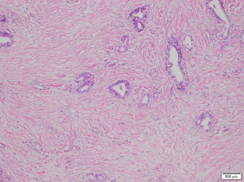 Case 1: A photomicrograph of the diagnostic histopathology shows a moderately differentiated adenocarcinoma of the gastroesophageal junction. Adenocarcinoma cells show cytological atypia and mitoses. Malignant cells are seen to form small atypical glands and cell nests that invade fibrotic stroma. Hematoxylin and eosin stain. Magnification ×40.