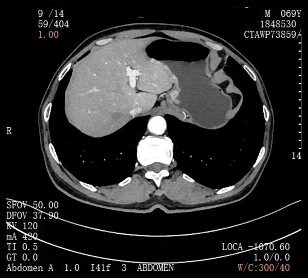 Case 2: Computed tomography for the diagnosis of esophageal and gastric junction carcinoma.