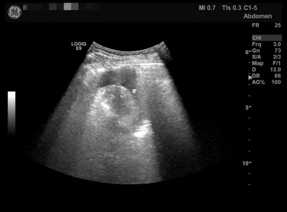 Case 2: Pericardial ultrasound indicates pericardial effusion.