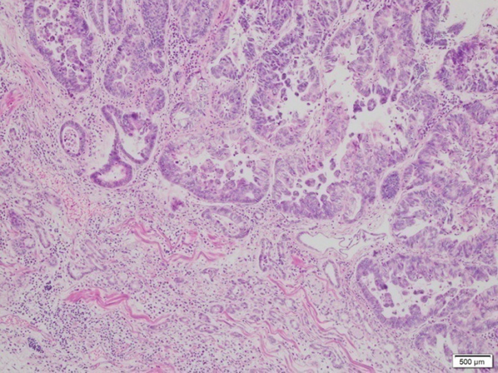 Case 2: A photomicrograph of the diagnostic histopathology shows a moderately differentiated adenocarcinoma of the gastroesophageal junction. Adenocarcinoma cells form irregular and cohesive glands with invasive single cells and cell nests. Cell and tissue necrosis is also shown. Hematoxylin and eosin stain. Magnification ×40.