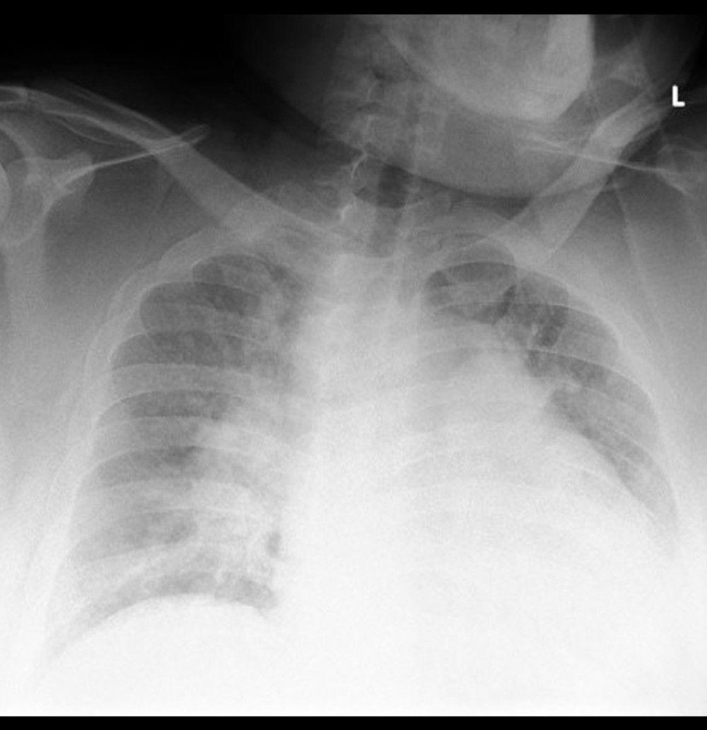 Chest X-ray at ICU admission. Chest X-ray shows cardiomegaly and enhanced pulmonary hilar shadow.