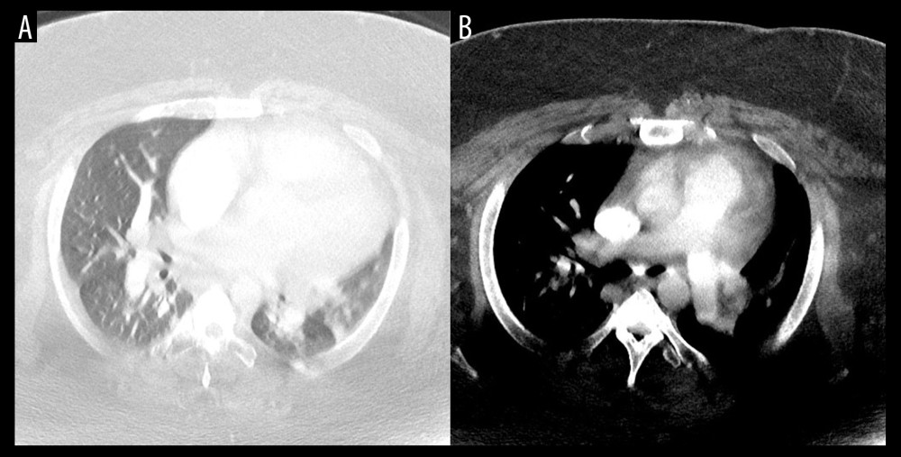 Chest computed tomography (CT). (A) CT of pulmonary field striations shows that there are no findings of ground-glass opacity and there are heavy subcutaneous fats. There is no infiltrative shadow, pleural effusion, or atelectasis. (B) Contrast-enhanced CT shows that there is no thrombus in the pulmonary artery.