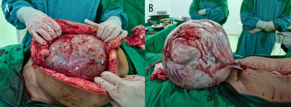 (A) A huge mass was seen after the abdomen was opened. A mild adhesion to the omentum was note. (B) A huge left ovarian mass was seen. The bloody area in the capsule of the mass was the location of omental adhesion.
