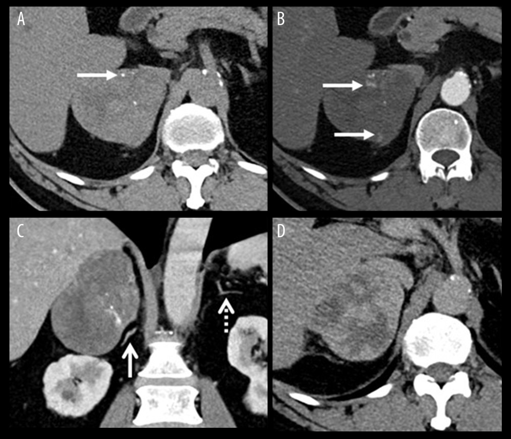 (A) Non-contrast computed tomography (CT) shows a right adrenal mass with inhomogeneous density and punctate calcifications (arrow). (B) Arterial phase post-contrast CT reveals few foci of peripheral enhancing nodules (arrow). (C) Coronal reformatted image in the portovenous phase shows the mass arising from the hepatic limb of the right adrenal gland with the preserved crural limb (arrow) and the normal left adrenal gland (arrow). (D) A 15-minute delayed image shows progressive contrast enhancement; however, the mass still shows heterogeneity.