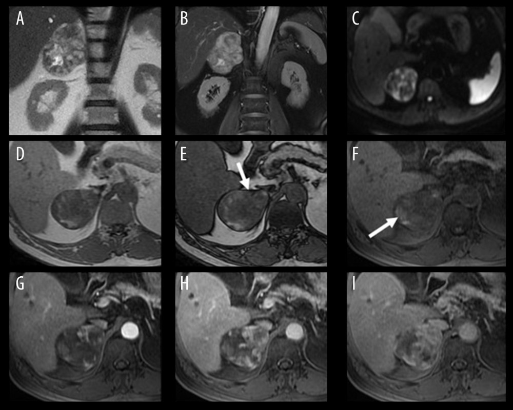 Magnetic resonance imaging: (A) coronal T2-weighted, and (B) fat-suppressed steady-state free precession images show the heterogeneous signal intensity of the right adrenal mass. (C) Axial diffusion-weighted image (DWI, b-value=800 s/mm2) shows some areas of restricted diffusion. (D) Axial in-phase and (E) opposed-phase gradient echo T1-weighted images also reveal a heterogeneous signal. A small area of signal drop in the opposed-phase image (arrow) may represent intracytoplasmic fat. (F) Non-contrast fat-suppressed gradient echo T1-weighted image reveals that the T1-hyperintense foci (arrow) are intratumoral hemorrhages. (G–I) Late arterial phase, portal venous phase, and 10-minute delayed, post-contrast, fat-suppressed T1-weighted images show peripheral early enhancement with progressive heterogeneous enhancement in later-phase images.