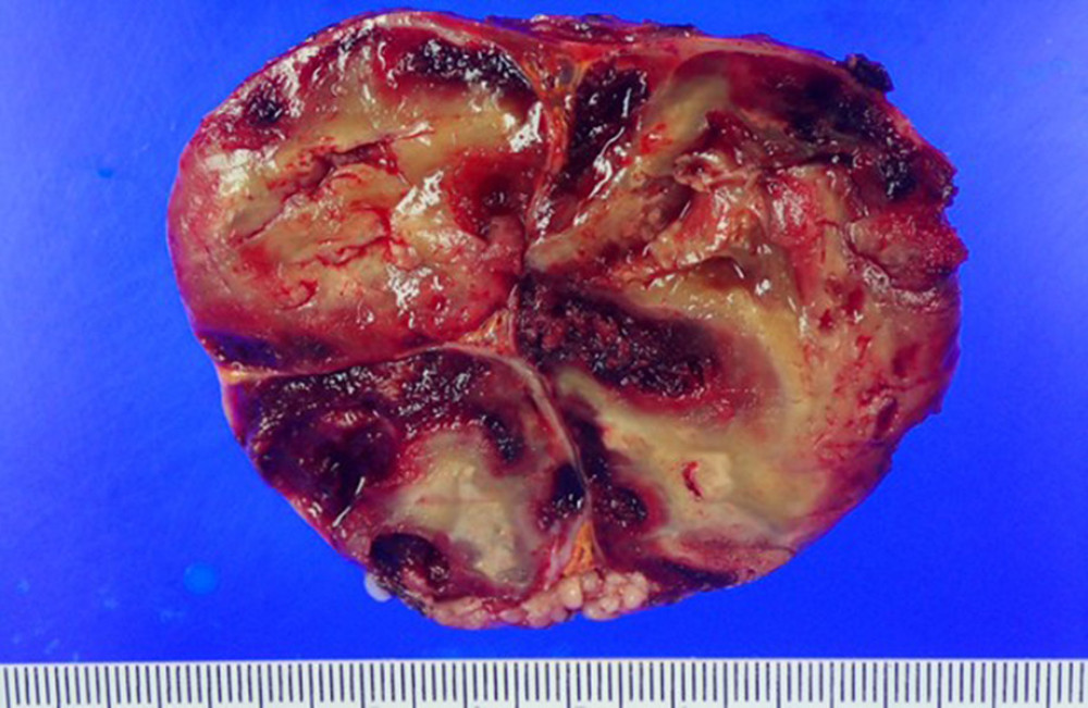 Gross morphology of the adrenal mass showing multiple nodules with yellow-tan cut surfaces and red hemorrhagic areas.