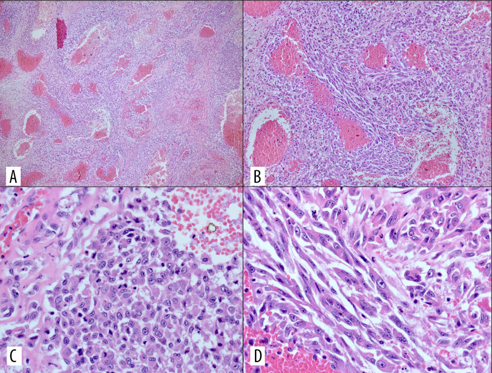 Histopathology of the adrenal gland tumor. (A) Low magnification reveals a highly cellular tumor with vascular channels (hematoxylin and eosin [H&E] 40×). (B) Medium magnification reveals tumor cells with epithelioid and spindle shapes (H&E 100×). (C) High magnification reveals pleomorphic epithelioid tumor cells with hyperchromatic nuclei, prominent nucleoli, and vesicular chromatin (H&E 400×). (D) High magnification reveals pleomorphic spindle-shaped tumor cells with hyperchromatic nuclei, prominent nucleoli, and vesicular chromatin (H&E 400×).