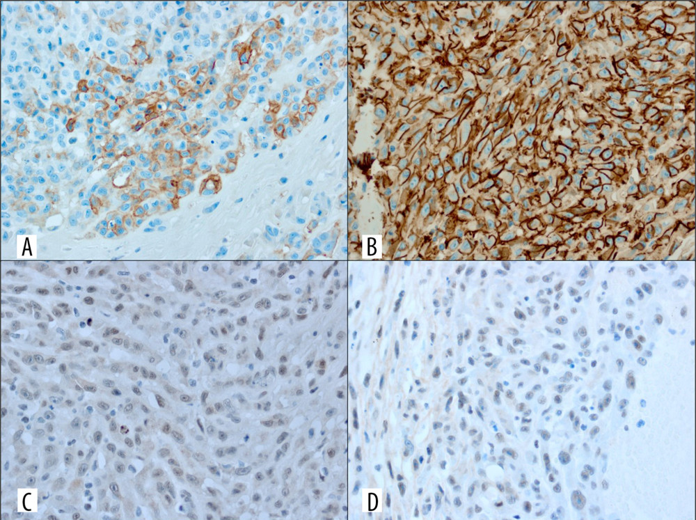 Immunohistochemical staining of the adrenal tumor: (A) cytokeratin, (B) CD31, (C) FLI-1, and (D) INI-1 (400×).