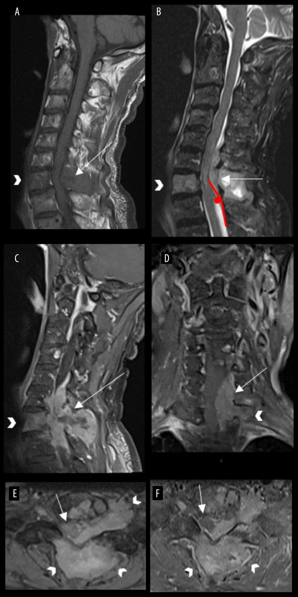 Preoperative MRI scans of an 82-year-old man who presented with a spinal tumor. (A) Sagittal T1-weighted (W) and (B) T2W pre-contrast images show a T1 hypo-and T2 hyper-intense spinal tumor infiltrating the C7 vertebra (arrowheads) and (lesser extend) T1 vertebral body. The tumor extends from C5 to T2 vertebral levels. The tumor makes an obtuse angle (red angle) with the longitudinal flow of the cerebrospinal fluid (CSF) on the sagittal image (B). This indicates the extra-dural location of the tumor. It causes a significant mass effect on the spinal cord, with focal high T2 cord signal (red arrows, B). (C) Sagittal and (D) coronal T1-weighted post-contrast images show the left lateral extradural tumor compresses the spinal cord/thecal sac and extends into the paraspinal region as well as widening the left C7-T1 neural foramen (arrowhead, D). (E) Axial T2W and (F) T1W post-contrast images show the extradural tumor displaces the spinal cord and thecal sac (arrows, E and F) to the right half of the spinal canal and extends into the posterior paraspinal space with widening of the left neural foramen (arrowheads, E and F).