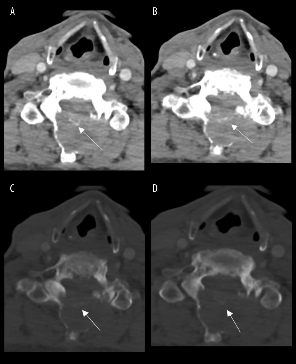 Contrast tomographic (CT) scans of the neck of the 82-year-old man. (A, B) Axial CT scans of the soft tissues and (C, D) bone window across C6 vertebra showing an expansile posterior epidural soft-tissue mass causing marked bony erosion of the laminae, facets, and spinous process. There are also faint hyperdensities in the posterior C6 level within the mass (arrows), indicating intratumoral calcification (arrows).