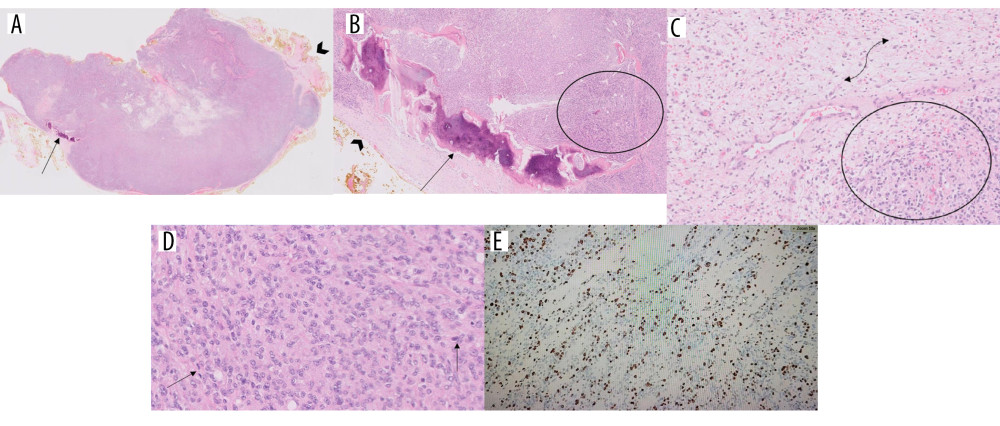 Histopathological examination of the extradural tumor specimen of the 82-year-old man. (A, B) Low-power photomicrographs of the tumor sections (hematoxylin-eosin stain, original magnification ×5 [A], ×20 [B]) reveal a well-circumscribed mesenchymal tumor with osseous fibrous rim (arrows) and thick collagenous capsule (arrowheads). (C) High-power photomicrographs (hematoxylin-eosin stain, original magnification ×100 [C], ×200 [B]) reveal uniformly round-to-ovoid-shaped tumor cells arranged in nests of clusters (circles, B, C) within a myxoid and hyalinized stromal matrix (curve arrow, C) indicating its stromal origin. There is scattered nuclear atypia with mitotic activity in 2 per 50 high-power fields (arrows, D). Immunohistochemistry (not shown) of the tumor specimen reveals strong positivity for vimentin, and patchily positive for EMA, CD99 and AE 1/3. (E) There is a high Ki67 proliferation index of 40–50% (original magnification ×10). Overall microscopic examination reveals a malignant ossifying fibromyxoid tumor FNCLCC (Federation Nationale des Centres de Lutte Contre le Cancer) grade 2.