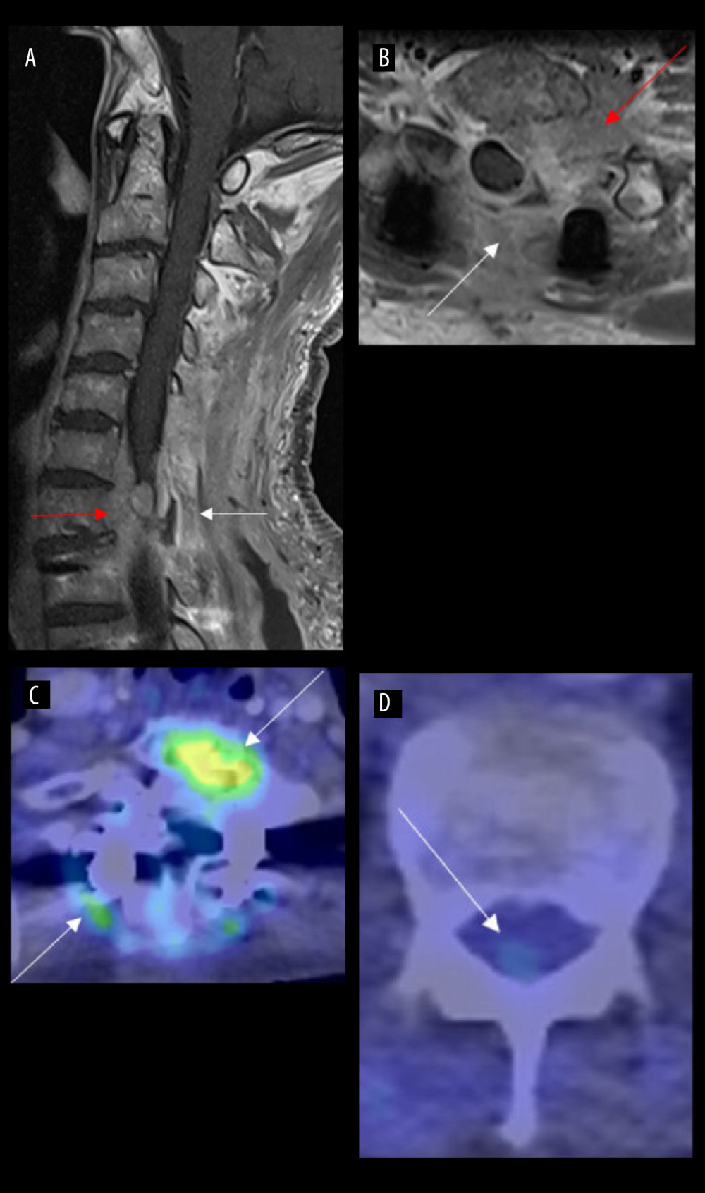Postoperative MRI and PET-CT scans of an 82-year-old man following tumor debulking. (A) Sagittal and (B) axial T1-weighted (W) MR images performed following posterior laminectomy and tumor debulking show residual tumor predominantly in the anterior epidural space at C7 level (red arrows). Note the post-laminectomy changes on the sagittal T1W post-contrast image (white arrows). (C) Axial positron emission tomographic-computed tomography (PET-CT) image at C7 level shows focal increased 18F-FDG uptake at the anteromedial aspect of the C7 vertebral region, with maximum standardized uptake values, SUVmax=25, indicating residual tumor (red arrow, C) while the mild focal uptake at the right paraspinal soft tissue (SUVmax=8) represents a post-treatment effect (white arrow, C). (D) Axial PET-CT image at L1 level shows a faint focal uptake in the posterior aspect of the conus medullaris (SUVmax=3.5), which was indeterminate at the time of scanning, but subsequent follow-up showed it to be a drop metastasis.