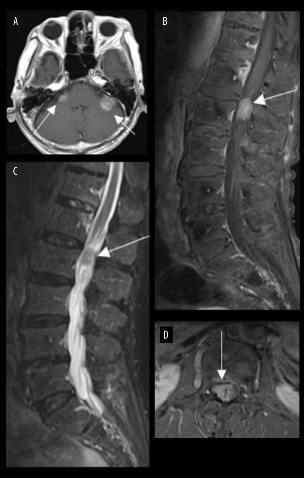 Six-month follow-up MRI brain and lumbar spine scans of an 82-year-old man after debulking of an extradural tumor. (A) Axial T1W post-contrast MRI brain image reveals enhancing lesions in bilateral cerebellopontine angles, presumed to be metastatic in nature (arrows). (B) Sagittal T2W and (C) sagittal and (D) axial T1W post-contrast MRI lumbar spine images show a T2 isointense signal lesion at the conus medullaris with corresponding ‘flame-shaped’ enhancement pattern (arrow, C). This raises the suspicion of a metastatic lesion. Following surgical resection of the conal lesion, the microscopic examination confirms a ‘drop’ metastasis of an ossifying fibromyxoid tumor.