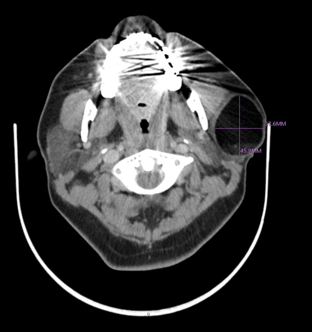 CT scan of the head and neck showing a 4.7 cm well-defined, encapsulated, fat-attenuating, and non-enhancing mass within the superficial left parotid gland with some layering debris. No associated nodular enhancing soft-tissue component was observed.
