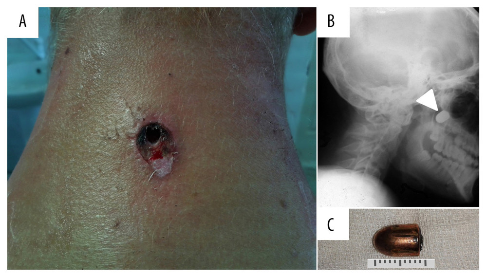 A 16-year-old Ukrainian boy shot at close-range to the back of the neck with a handgun. (A) The entrance wound at the back of the neck is from a Makarov pistol and shows some tissue damage and blood clot. (B) A lateral X-ray of the head and neck shows the bullet trajectory and the location of the bullet lodged in the left pterygopalatine fossa, deep to the infratemporal fossa, and posterior to the maxilla. (C) The 9×18-mm bullet shell was removed, intact, following surgery.
