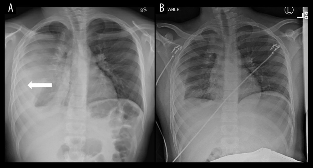 Chest X-ray: On the left (A), the arrow indicates a thickened pleura. There is obliteration of the right costophrenic angle with fluid tracking along the right lateral pleura into the major and minor fissures. The fluid does not collect along the dependent aspects of the medial hemithorax, suggesting it is loculated. There is associated consolidation and/or compressive atelectasis of the right middle and lower lobes. On the right (B), shows chest X-ray after chest tube removal prior to first admission discharge. There is no radiographic evidence for a pneumothorax. There is persistent right pleural effusion with possible loculation and right basilar compressive atelectasis, unchanged.