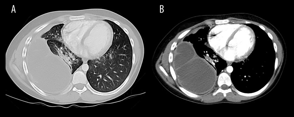 (A, B) Computed tomography showing large loculated peripherally enhancing pleural effusion along the posterolateral hemithorax tracking into the anteroinferior pleural space and into the minor, major, and azygos fissures. Findings are most consistent with an empyema. There is right hilar adenopathy. There is no evidence of cervical, mediastinal, or axillary adenopathy.