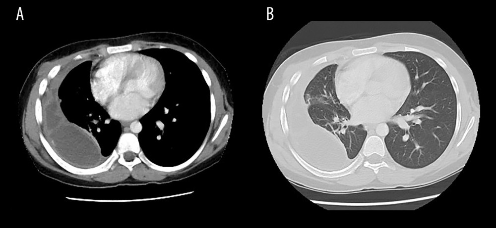 (A, B) Computed tomography showing improved right lung tree-in-bud opacities with decreased right multiloculated right pleural effusion. Thin fluid-filled right chest wall sinus tract is probably site of previous chest tube drainage. Right lower lobe decreased size mass-like opacity is possibly small pulmonary abscess of 1.9 cm. Stable pleural space multifocal periphery calcified nodular thickening is shown.