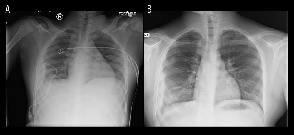 Chest X-ray before (A) and after (B) right chest tube removal on second admission prior to discharge. No pneumothorax is seen.