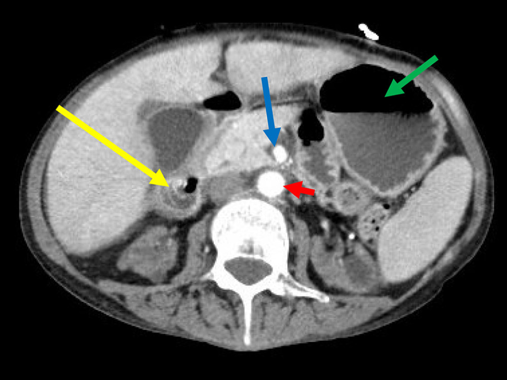 Axial computed tomography (left) demonstrating aorta (red arrow) and superior mesenteric artery (blue arrow), causing a reduced aorto-mesenteric distance and compression at the third portion of the duodenum with proximal dilation of the duodenum (yellow arrow) and stomach (green arrow).