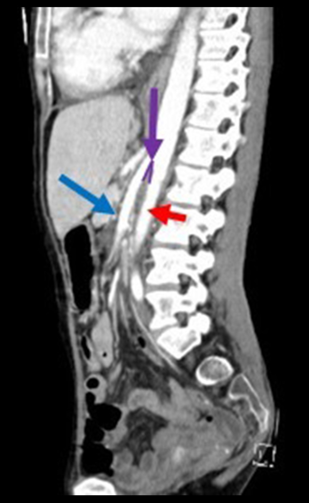Sagittal computed tomography (right) demonstrating the superior mesenteric artery (blue arrow) arising from the aorta (red arrow), forming a narrow aortosuperior mesenteric artery of 16° (purple arrow).
