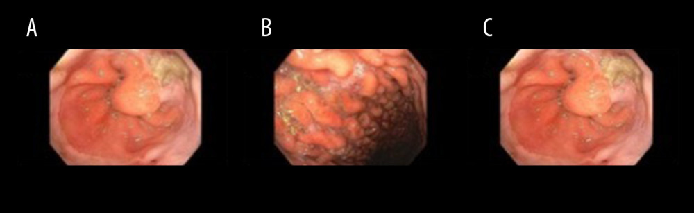 Esophagogastroduodenoscopy findings of esophagitis in the lower one-third of the esophagus (A), gastritis in the gastric body (B), and tight angulation in third portion of the duodenum (C).
