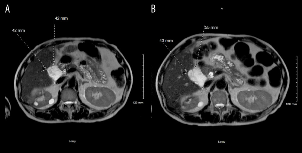 Initial MRI (A) showing 4.2×4.2 cm lesion with follow-up MRI (B) showing an increase in the size of the lesion to 5.5×4.3 cm.