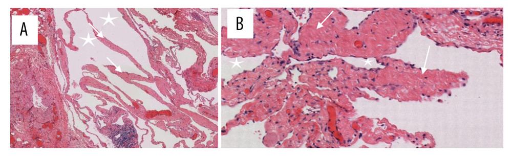 Cystic lumen (star) with supporting fibro cellular stroma (A) and proliferation of variable-sized vascular channels (arrow) (hematoxylin and eosin stain) (B).