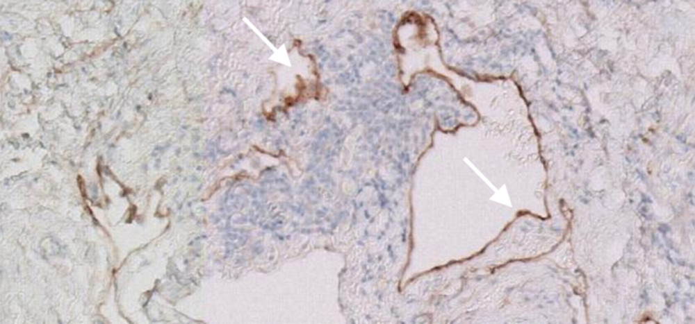 D2-40 lining the lymphatic endothelium of the cystic lesion.