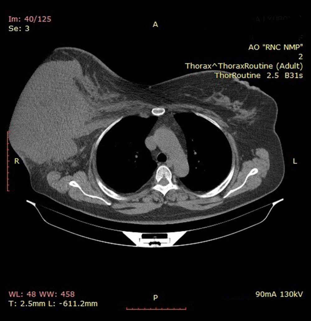 Photograph of chest CT from a 45-year-old woman with a primary leiomyosarcoma of the breast showing a large lobulated heterogeneous mass of the right breast mass of 18.0×18.0×15.0 cm in size with invasion of both pectoralis muscles and enlarged right axillary lymph nodes.