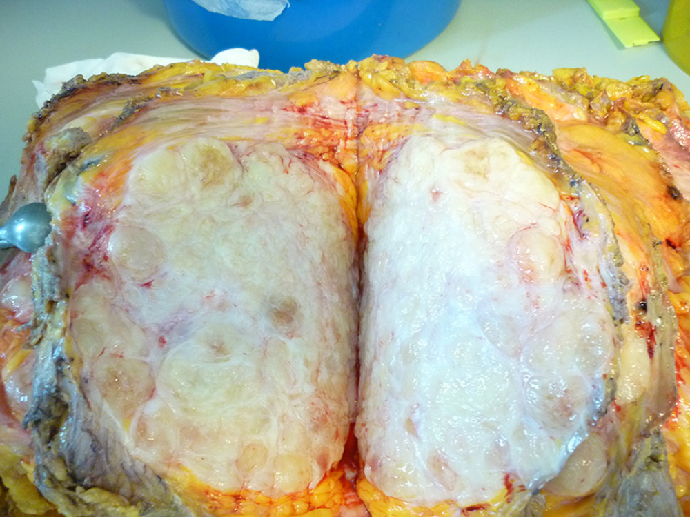Gross photograph of a mastectomy specimen from a 45-year-old woman with a primary leiomyosarcoma of the breast shows a gray-white, hard, well-circumscribed, and fungating tumor measuring 21.0×16.0×12.0 cm in size.