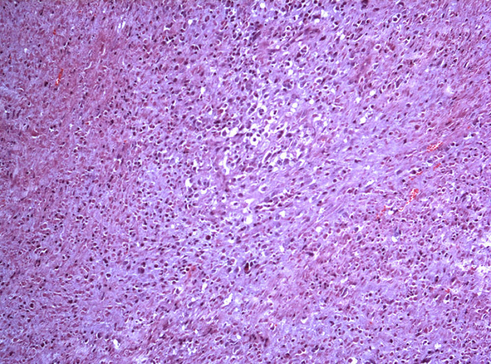 Photomicrograph of histology of the excised breast tumor from a 45-year-old woman with a primary leiomyosarcoma of the breast. The histopathology shows atypical mitoses and areas of necrosis (H and E; ×200).