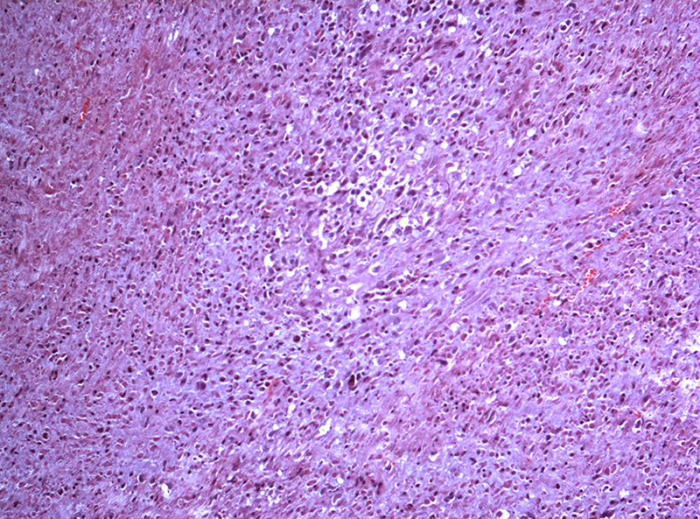 Photomicrograph of histology of the excised breast tumor from a 45-year-old woman with a primary leiomyosarcoma of the breast. The histopathology shows atypical mitoses and areas of necrosis (H and E; ×200).