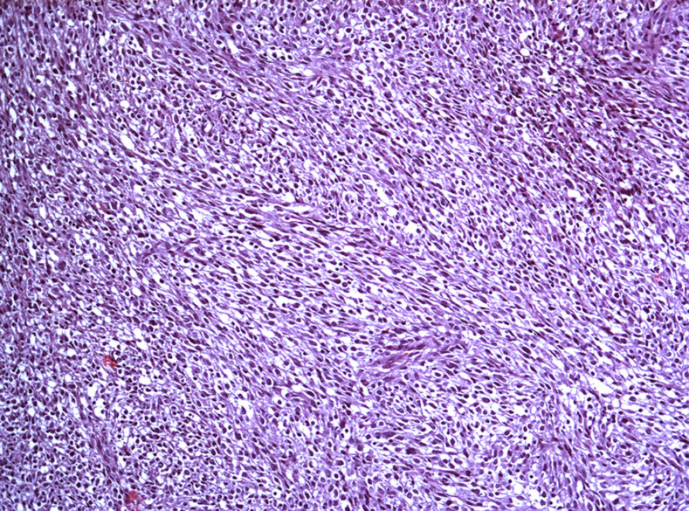 Photomicrograph of histology of the excised breast tumor from a 45-year-old woman with a primary leiomyosarcoma of the breast. The histopathology shows a poorly circumscribed tumor with spindle-toelongated cells arranged in intersecting fascicles and bundles (H and E; ×200).