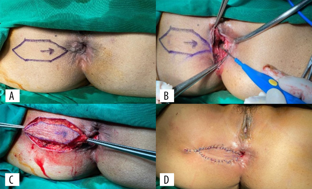 Anal repair and diamond flap. (A) The diamond flap design for incision; (B) the excision of scar tissue at 6 and 9 o’clock directions; (C) the incision of the diamond flap shape without injuring the vascular; and (D) the wound after the diamond flap was sutured.