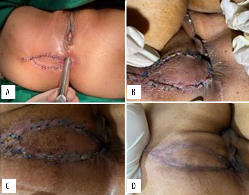 Postoperative wound healing. (A) The anal canal diameter after surgery was 2 cm; (B) the wound on postoperative day 10; (C) the wound on postoperative day 30; and (D) wound healing on postoperative day 45.