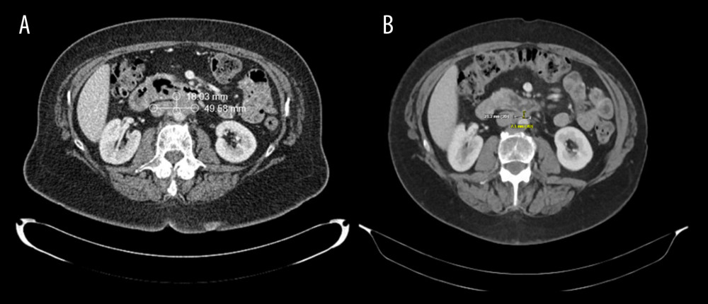 (A) Abdomen demonstrating 18.03×49.58 mm ill-defined retroperitoneal mass with invasion of the posterior third portion of the duodenum before the initiation of Pembrolizumab. (B) CT abdomen shows interval decrease ill-defined retroperitoneal mass size from 18.03×49.58 mm to 7.2×21.2 after 6 months of treatment with pembrolizumab.