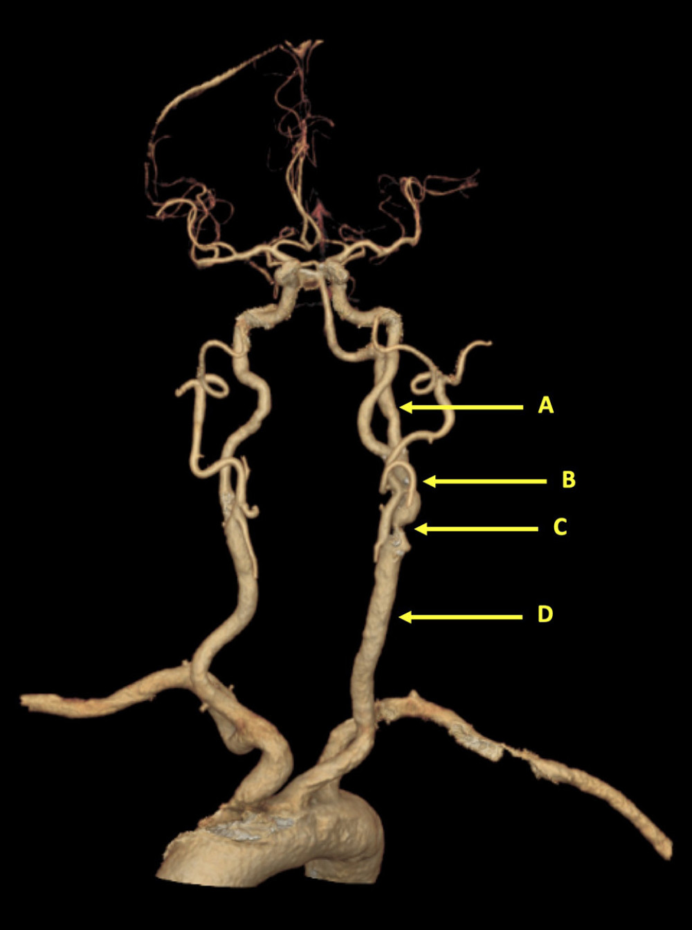 A 3-dimentional reconstruction of the Circle of Willis anatomy illustrating the persistent primitive hypoglossal artery. A) Left persistent patent hypoglossal artery (PPHA); B) left internal carotid artery; C) lesion at the left common carotid artery bifurcation; and D) left common carotid artery.