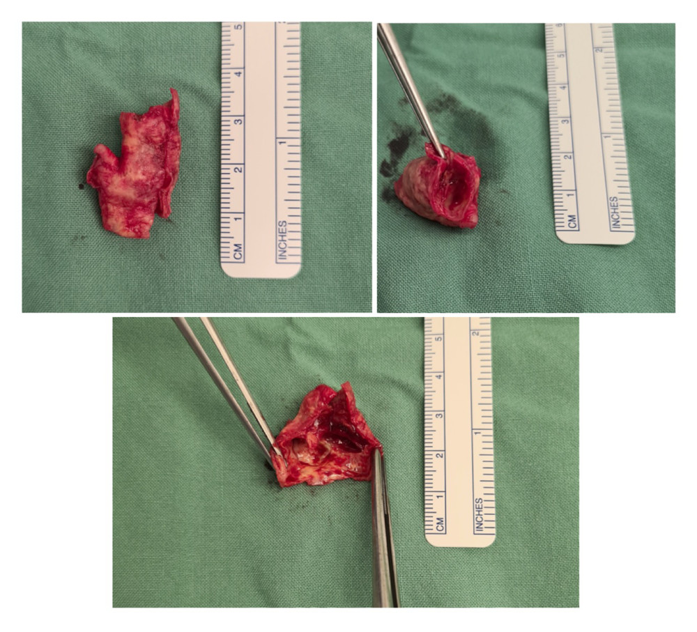 Intraoperative specimen illustrating the near occlusive soft hemorrhagic plaque from the origin of the left internal carotid artery.