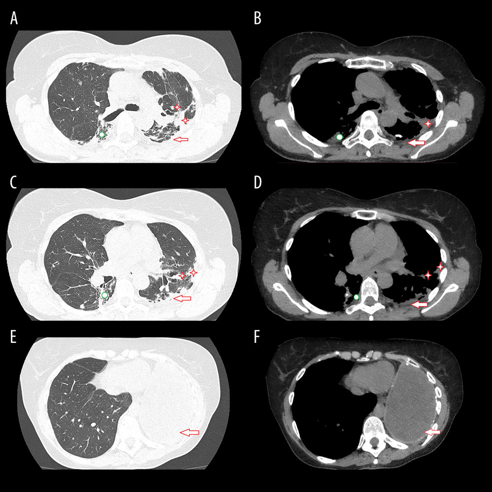 Computed tomography images of the chest at the time of presentation. Slices at the upper level – (A) lung window and (B) mediastinal window – showing a small pleural effusion on the left (arrow), with some dense striae extending to the lung parenchyma and some calcified foci (stars), in addition to reduced hemithorax volume; there are still images compatible with bronchiectasis in the posterior region of the right lung (circle). Slices at the middle level – (C) lung window and (D) mediastinal window – show pleural effusion with a dense appearance on the left (arrow), with thickened pleural leaflets and interspersed calcified foci (stars), in addition to reduced hemithorax volume; there are still images compatible with bronchiectasis in the posterior region of the right lung (circle). Slices at the lower level – (E) lung window and (F) mediastinal window – showing dense-looking pleural effusion occupying the left hemithorax (arrow).