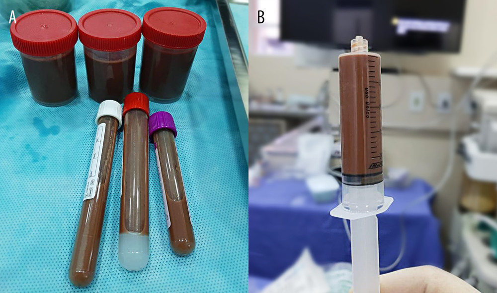 (A) Thick, chocolate-colored pleural fluid. (B) Color detailing with drained pleural fluid.