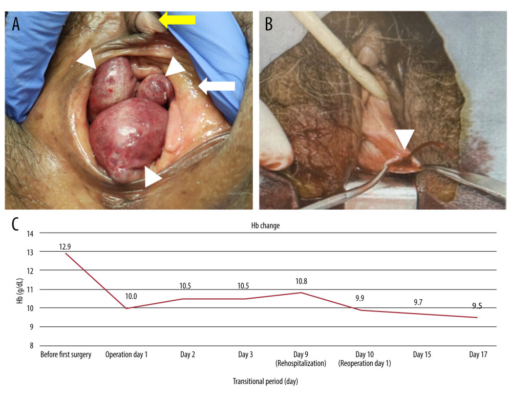 (A) Hemangioma protruding from the vagina (white arrowhead); urethral meatus (yellow arrow); labia minora (white arrow). (B) Eruptive massive hemorrhage was noted with puncture of vaginal wall hemangioma (white arrowhead). (C) Hemoglobin (Hb) change during hospitalization and visits to previous physician.