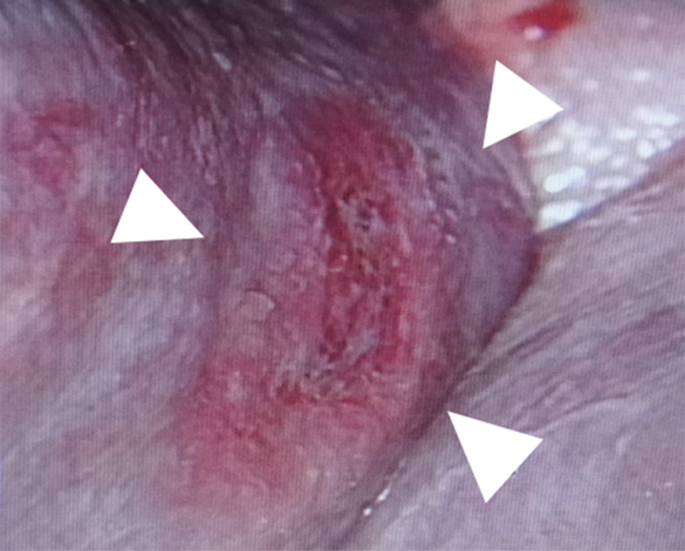 The right vaginal wall is visible using a vaginal speculum. Bleeding from vaginal wall at 9 o’clock (white arrowhead).