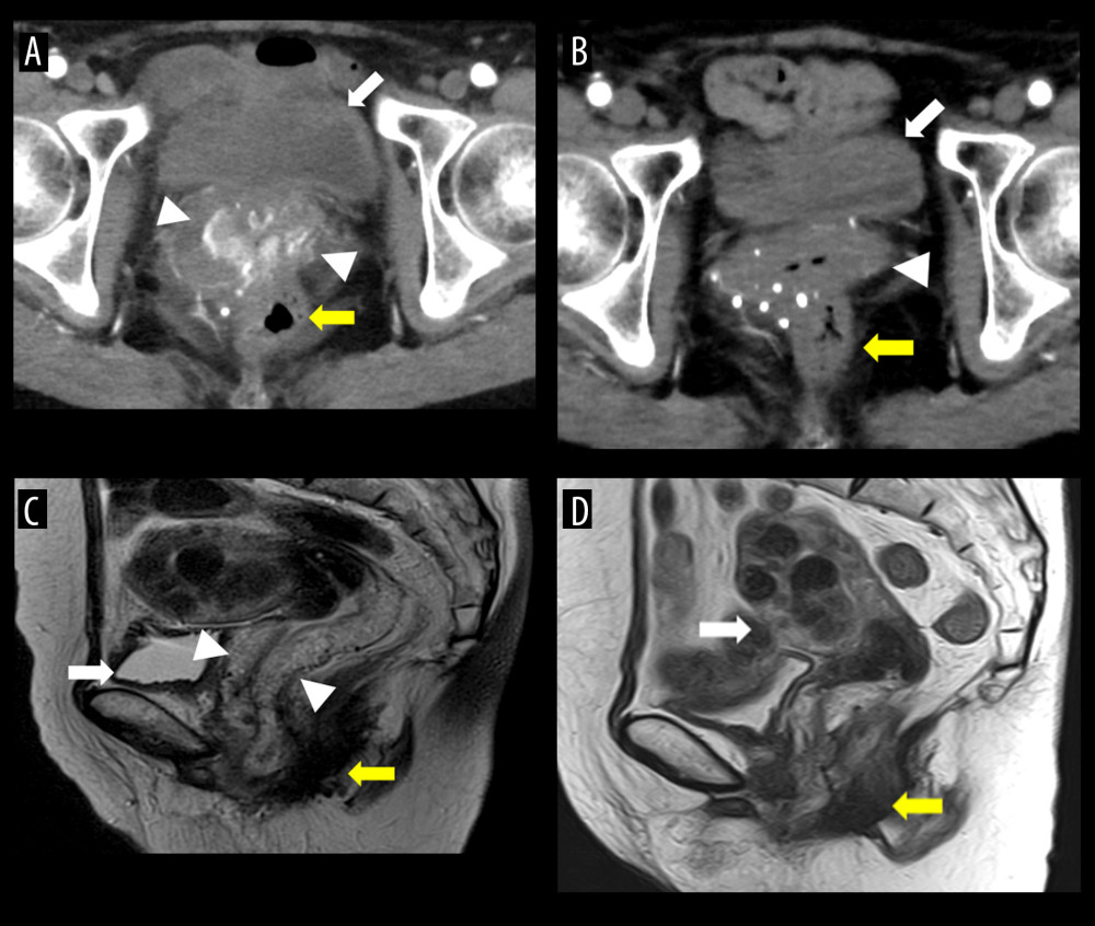 (A) Dynamic computed tomography scan (axial) of the pelvic region in the arterial layer showing a strong contrast effect in the entire vagina, which is suggestive of abundant blood flow (white arrowheads). Urinary bladder (white arrow), rectum (yellow arrow). (B) Two months after embolization. Vaginal wall hemangioma is obscured (white arrowhead); urinary bladder (white arrow); rectum (yellow arrow). (C) Contrast-enhanced magnetic resonance image (T2, sagittal) of the pelvic region showing the entire vaginal wall seemed to be replaced by a hemangioma with a diameter of 10 cm (white arrowheads); urinary bladder (white arrow); rectum (yellow arrow). (D) Four months after sclerotherapy; vaginal wall hemangioma became obscured; uterus (white arrow); vagina (yellow arrow).