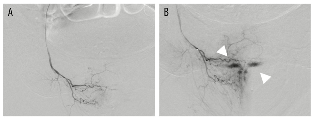 (A) Early layer of contrast injection to the right vaginal artery angiography. (B) Leakage of contrast medium observed from the peripheral blood vessels (white arrowhead), which was considered to be the cause of the bleeding.