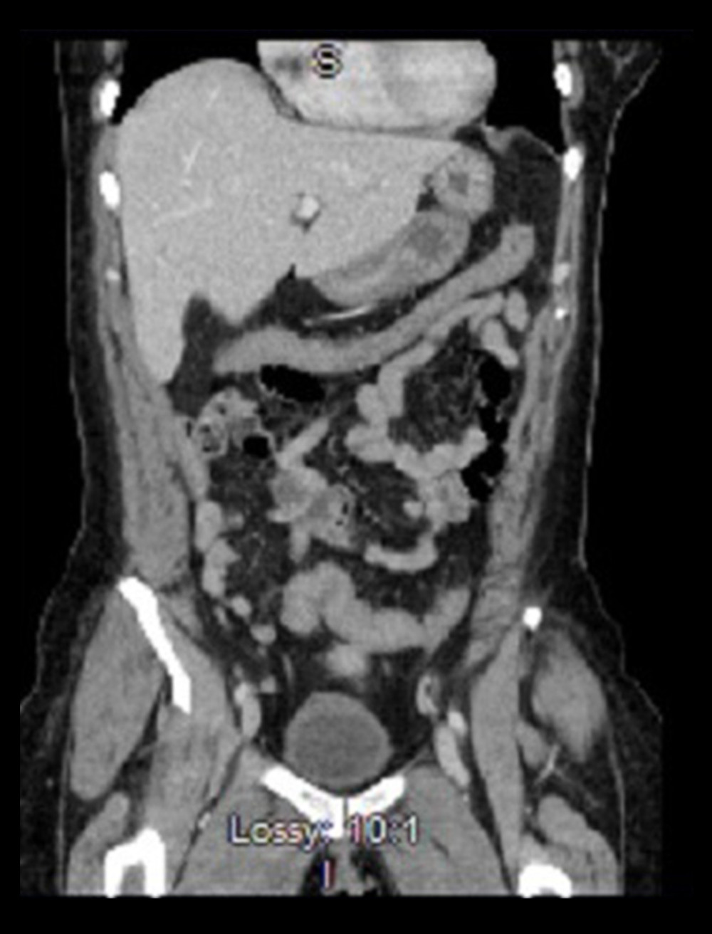 CT scan A/P on first admission, showing diffuse circumferential colonic wall thickening. The entire colon shows some questionable minimal peri-colonic hazy inflammation and thus the appearance of diffuse colitis.