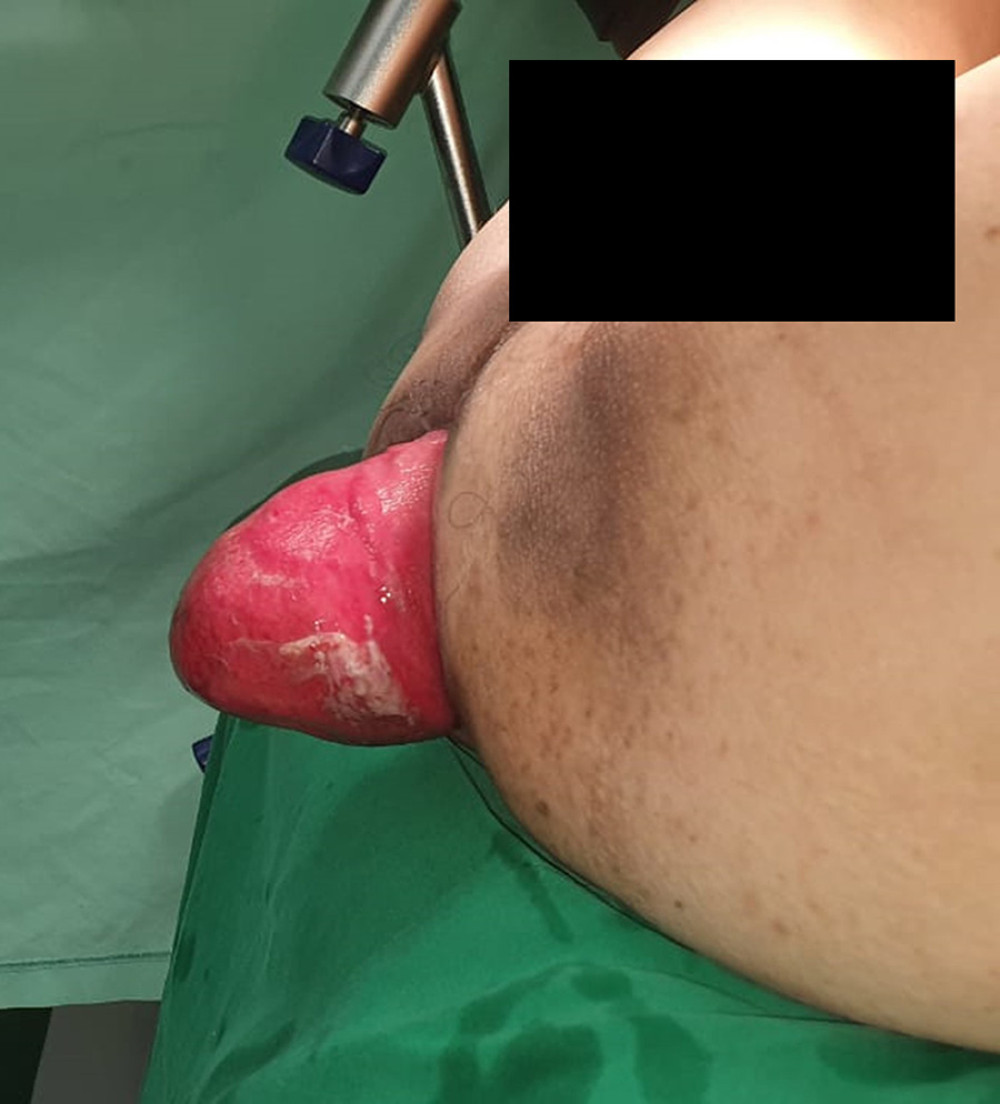 American Journal of Case Reports | A 54-Year-Old Man with a Large Rectal  Prolapse Treated with Perineal Proctosigmoidectomy with Levatorplasty  (Altemeier Procedure): Presentation of Case and Review of Literature -  Article abstract #